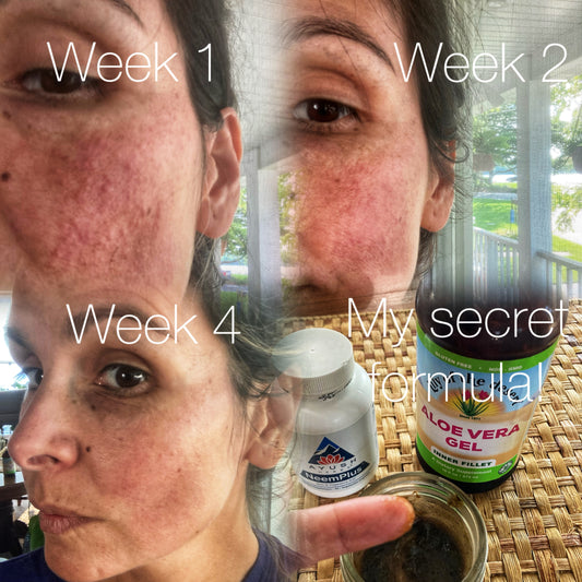 How did I heal my worst rosacea flare-up?